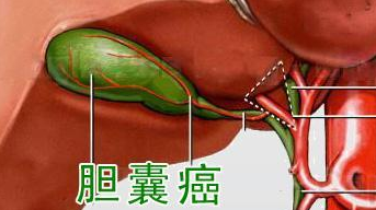 胆囊癌最新治疗，前沿技术与应用前景探索