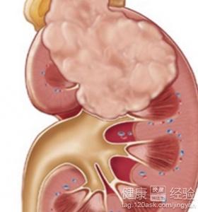 最新肾癌研究及治疗进展概述